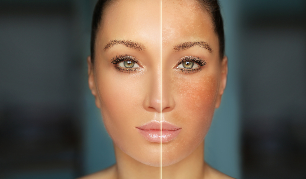 Hyperpigmentation Explained